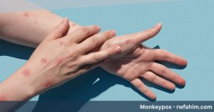 Monkeypox - rwfahim.com