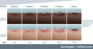 Monkeypox - rwfahim.com